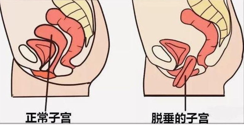 【围观】啥?子宫也能掉出来!(图3) 微信图片_20230107224200.png