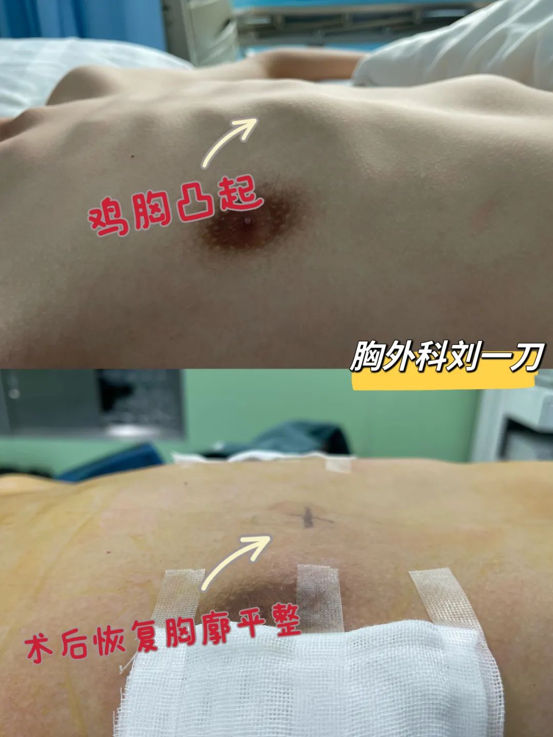 13岁男孩胸部畸形，一查竟是……
