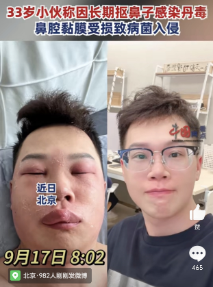 感染丹毒，33岁小伙面目全非!这个坏习惯你都有……小伙称因长期抠鼻子感染丹毒