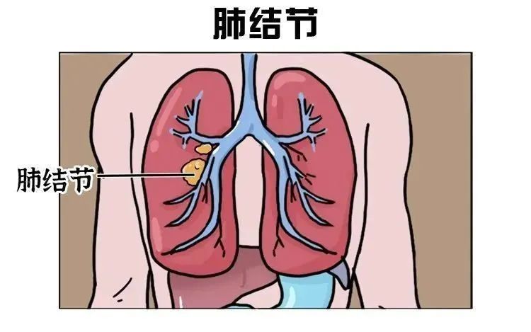 【当心】5mm结节癌变，有这些情况要注意